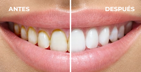 Comparación de sonrisas antes y después
